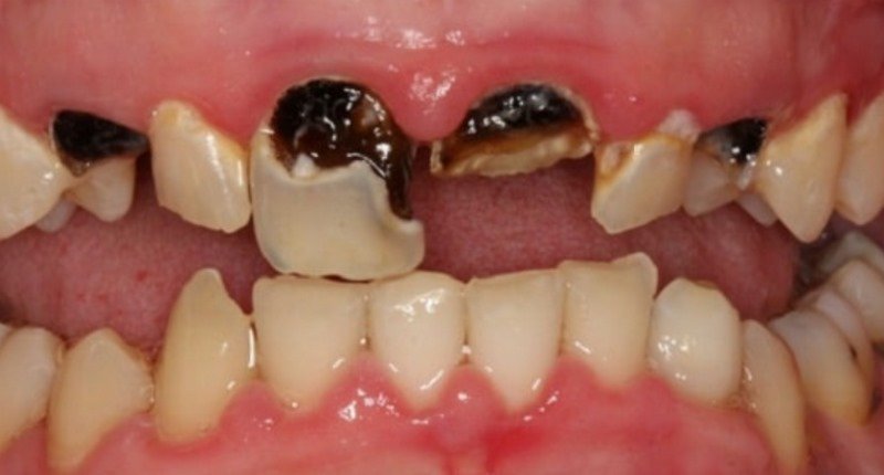 mơ thấy bị sâu răng cửa